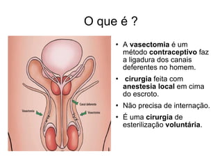 O que é ? A  vasectomia  é um método  contraceptivo  faz a ligadura dos canais deferentes no homem.  cirurgia  feita com  anestesia local  em cima do escroto.  Não precisa de internação. É uma  cirurgia  de esterilização  voluntária . 