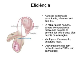 Eficiência As taxas de falha da vasectomia, são menores que 1%. A  maioria  dos homens sofrerá com pequenos problemas na pele do escroto por três a cinco dias depois da  operação.  Vantagem: Geralmente, anestesia local. Desvantagem: não tem proteção contra DSTs, não ganha peso. 