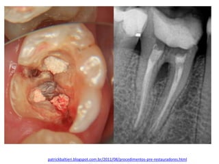 patrickbaltieri.blogspot.com.br/2011/08/procedimentos-pre-restauradores.html
 