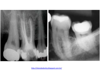 http://vhendodontia.blogspot.com.br/
 