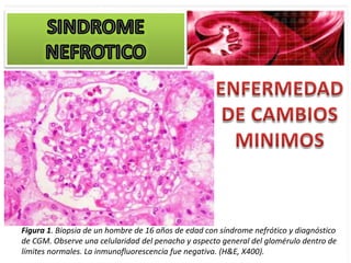Figura 1. Biopsia de un hombre de 16 años de edad con síndrome nefrótico y diagnóstico
de CGM. Observe una celularidad del penacho y aspecto general del glomérulo dentro de
límites normales. La inmunofluorescencia fue negativa. (H&E, X400).
 