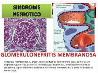 Nefropatía membranosa. A. engrosamiento difuso de la membrana basal glomerular. B.
diagrama esquematico que ilustra los depósitos sibepiteliales, emborronamiento de los
pedicelios y la presencia de espinas de materail de la membrana basal entre los depósitos
inmunitarios.
 