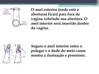 O anel exterior (onde está a abertura) ficará para fora da vagina cobrindo sua abertura. O anel interior será inserido dentro da vagina. Segure o anel interior entre o polegar e o dedo do meio como mostra a ilustração e pressione. 