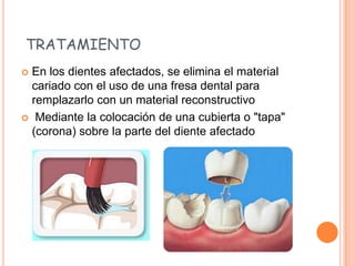 TRATAMIENTO
 En los dientes afectados, se elimina el material
cariado con el uso de una fresa dental para
remplazarlo con un material reconstructivo
 Mediante la colocación de una cubierta o "tapa"
(corona) sobre la parte del diente afectado
 