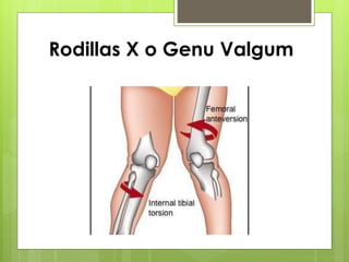 Rodillas X o Genu Valgum 
 