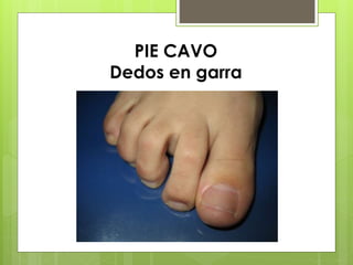 PIE CAVO 
Dedos en garra 
 