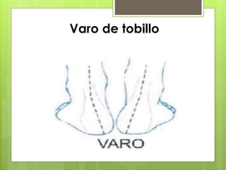 Varo de tobillo 
 