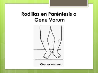 Rodillas en Paréntesis o 
Genu Varum 
 