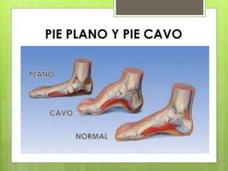 PIE PLANO Y PIE CAVO 
 