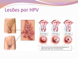 Lesões por HPV
 