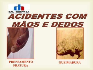 PRENSAMENTO
FRATURA
QUEIMADURA
 