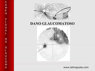 C
A
M
P
O

V
I
S   DANO GLAUCOMATOSO
U
A
L

N
O

G
L
A
U
C
O
M
A               www.telmajusta.com
 