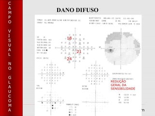 C
A
M
    DANO DIFUSO
P
O

V
I
      18
S
U
A          21
L
      24
N
O

G
L                    REDUÇÃO
                     GERAL DA
A                    SENSIBILIDADE
U
C
O
M
A                 www.telmajusta.com
 