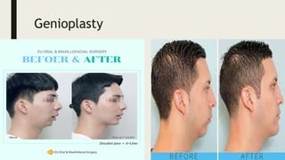 Genioplasty
 