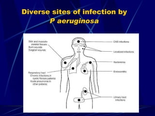 Diverse sites of infection by
       P aeruginosa
 