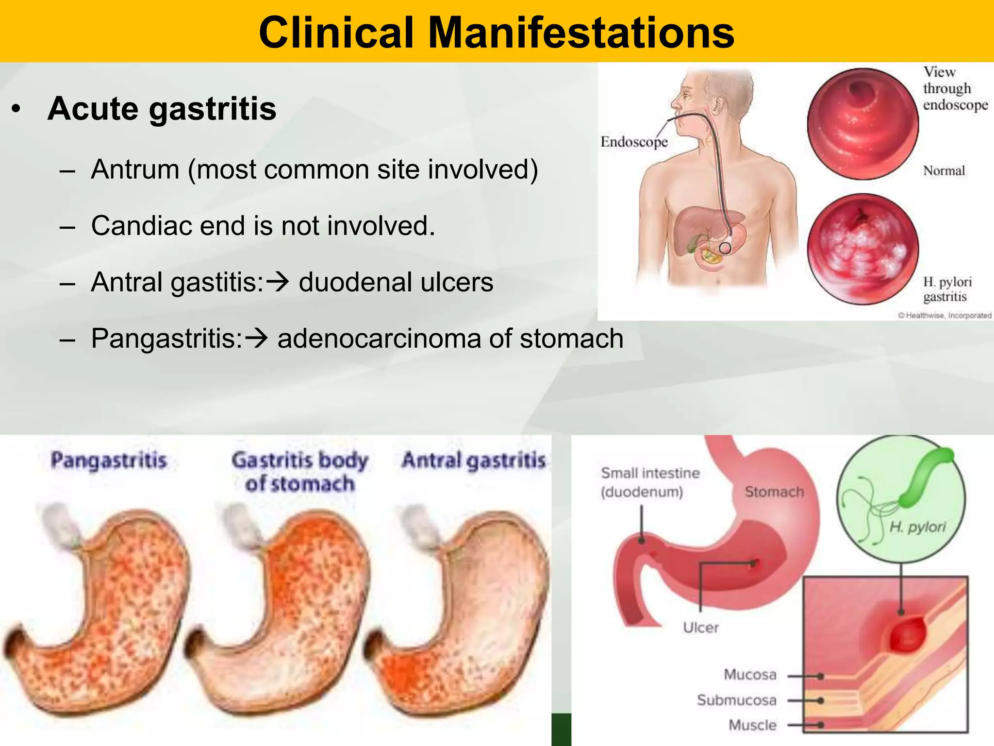 Clinical Manifestations
• Acute gastritis
– Antrum (most common site involved)
– Candiac end is not involved.
– Antral gastitis: duodenal ulcers
– Pangastritis: adenocarcinoma of stomach
 