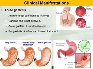 Clinical Manifestations
• Acute gastritis
– Antrum (most common site involved)
– Candiac end is not involved.
– Antral gastitis: duodenal ulcers
– Pangastritis: adenocarcinoma of stomach
 