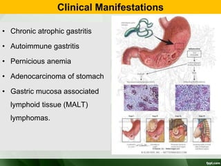 Clinical Manifestations
• Chronic atrophic gastritis
• Autoimmune gastritis
• Pernicious anemia
• Adenocarcinoma of stomach
• Gastric mucosa associated
lymphoid tissue (MALT)
lymphomas.
 