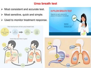 Urea breath test
 Most consistent and accurate test.
 Most sensitive, quick and simple.
 Used to monitor treatment response.
 