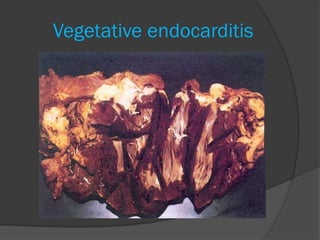Vegetative endocarditis
 
