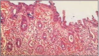 Clinical manifestations
• Clinical manifestations lasts 5 to 7 days in healthy individuals.
• Includes:
Enteritis
Diarrhea
Fever
Severe abdominal pain
 