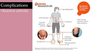 Complications
•Reactive arthritis
 