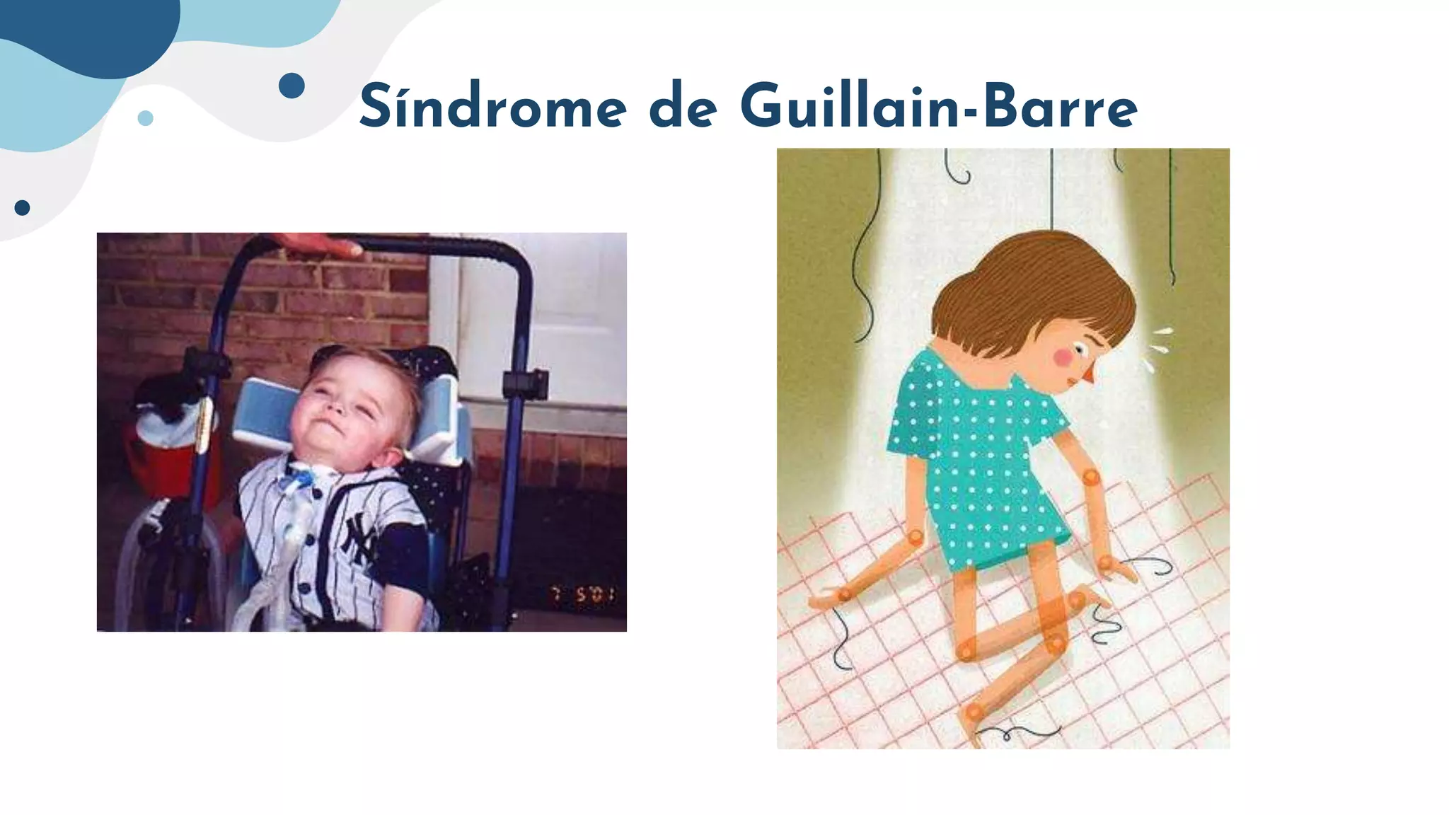 Síndrome de Guillain-Barre