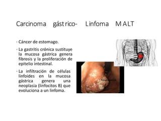 Carcinoma gástrico- Linfoma M ALT
• Cáncer de estomago.
• La gastritis crónica sustituye
la mucosa gástrica genera
fibrosis y la proliferación de
epitelio intestinal.
• La infiltración de células
linfoides en la mucosa
gástrica genera una
neoplasia (linfocitos B) que
evoluciona a un linfoma.
 