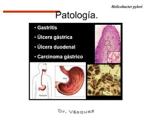 Helicobacter pylori

Patología.
 