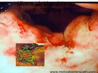 Ulcera gástrica vista por
      endoscopia
 