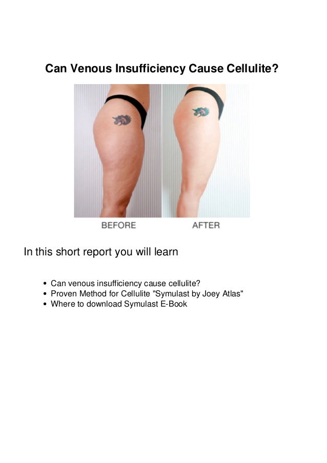 Can Venous Insufficiency Cause Cellulite