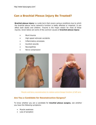 http://www.hpcsurgery.com/
Can a Brachial Plexus Injury Be Treated?
Brachial plexus injury is a wide term that covers various conditions due to which
the brachial plexus nerve network’s function is badly affected or impaired. It can
affect both adults and children. Trauma is the major reason for most of these
injuries. Given below are some of the common causes of brachial plexus injury:
• Blunt trauma
• High speed vehicular accidents
• Inflammatory processes
• Gunshot wounds
• Neuropathies
• Nerve compression
Muscle and bony reconstruction to restore active biceps function of left arm
Are You a Candidate for Reconstructive Surgery?
To know whether you are a candidate for brachial plexus surgery, see whether
you have the following symptoms:
• Muscle weakness
• Loss of sensation
 
