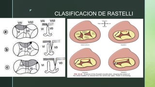 Canal auriculoventricular cardiología pediatra | PPTX