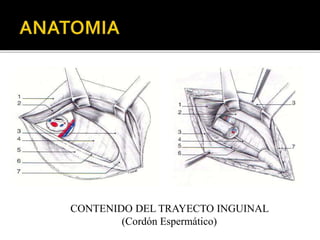 CONTENIDO DEL TRAYECTO INGUINAL
(Cordón Espermático)
 