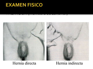 PALPACION (Maniobra de Landivar)
Hernia directa Hernia indirecta
 
