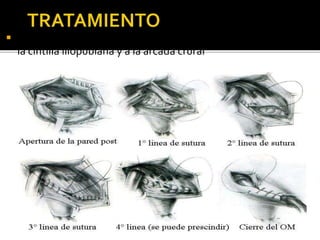  Shouldice: imbricación de suturas que unen el om-transverso a
la cintilla iliopubiana y a la arcada crural
 