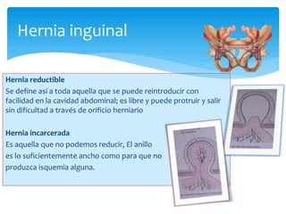 Hernia inguinal
Hernia reductible
Se define así a toda aquella que se puede reintroducir con
facilidad en la cavidad abdominal; es libre y puede protruir y salir
sin dificultad a través de orificio herniario
Hernia incarcerada
Es aquella que no podemos reducir, El anillo
es lo suficientemente ancho como para que no
produzca isquemia alguna.
 