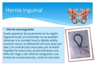 Hernia inguinal
 Hernia estrangulada
Suele aparecer bruscamente en la región
inguinocrural, el contenido no se pueden
retornar a la cavidad tras la rápida salida;
muchas veces, la dilatación de esas asas por
aire y la contracción muscular por el dolor
impiden la reducción, produciéndose una
falta de riego y de retorno sanguíneo con
todas las consecuencias, como la necrosis.
 