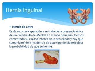 Hernia inguinal
 Hernia de Littre
Es de muy rara aparición y se trata de la presencia única
de un divertículo de Meckel en el saco herniario. Hemos
comentado su escaso interés en la actualidad y hay que
sumar la mínima incidencia de este tipo de divertículo a
la probabilidad de que se hernie.
 