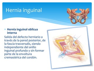 Hernia inguinal oblicua
interna
Salida del defecto herniario a
través de la pared posterior, de
la fascia trasversalis, siendo
independiente del anillo
inguinal profundo y sin formar
parte de la envoltura
cremastérica del cordón.
Hernia inguinal
 
