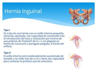Tipo I
Se trata de una hernia con un anillo interno pequeño,
estrecho, apretado, con capacidad de contención tras
la introducción del saco y colocación por encima de
una prótesis de Prolene® de 6 x 11 cm plegada en
forma de cucurucho o paraguas plegado, a través del
orificio.
Tipo II
El anillo interno está moderadamente aumentado de
tamaño y no mide más de 4 cm y tiene aún capacidad
para contener la prótesis que las soluciona.
Hernia inguinal
 