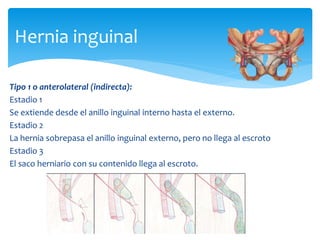 Tipo 1 o anterolateral (indirecta):
Estadio 1
Se extiende desde el anillo inguinal interno hasta el externo.
Estadio 2
La hernia sobrepasa el anillo inguinal externo, pero no llega al escroto
Estadio 3
El saco herniario con su contenido llega al escroto.
Hernia inguinal
 