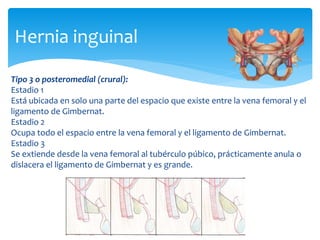 Tipo 3 o posteromedial (crural):
Estadio 1
Está ubicada en solo una parte del espacio que existe entre la vena femoral y el
ligamento de Gimbernat.
Estadio 2
Ocupa todo el espacio entre la vena femoral y el ligamento de Gimbernat.
Estadio 3
Se extiende desde la vena femoral al tubérculo púbico, prácticamente anula o
dislacera el ligamento de Gimbernat y es grande.
Hernia inguinal
 