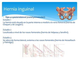  Tipo 4 o posterolateral (crural prevascular):
Estadio 1
La hernia está situada en la parte interna o medial a la vena femoral (hernia de
Cloquet y de Laugier).
Estadio 2
Localizada a nivel de los vasos femorales (hernia de Velpeau y Serafini).
Estadio 3
Se ubica de forma lateral, externa a los vasos femorales (hernia de Hesselbach
y Patridge).
Hernia inguinal
 