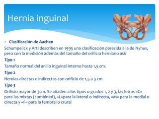  Clasificación de Aachen
Schumpelick y Artl describen en 1995 una clasificación parecida a la de Nyhus,
pero con la medición además del tamaño del orificio herniario así:
Tipo 1
Tamaño normal del anillo inguinal interno hasta 1,5 cm.
Tipo 2
Hernias directas e indirectas con orificio de 1,5 a 3 cm.
Tipo 3
Orificio mayor de 3cm. Se añaden a los tipos o grados 1, 2 y 3, las letras «C»
para las mixtas (combined), «L»para la lateral o indirecta, «M» para la medial o
directa y «F» para la femoral o crural
Hernia inguinal
 