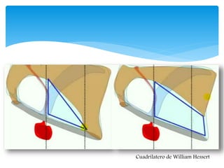 Cuadrilatero de William Hessert
 