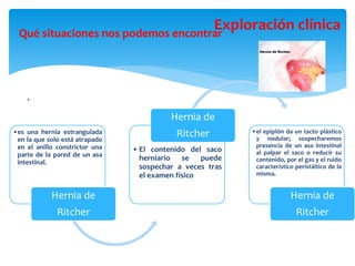 .
Qué situaciones nos podemos encontrar
Exploración clínica
•es una hernia estrangulada
en la que solo está atrapado
en el anillo constrictor una
parte de la pared de un asa
intestinal.
Hernia de
Ritcher
• El contenido del saco
herniario se puede
sospechar a veces tras
el examen físico
Hernia de
Ritcher •el epiplón da un tacto plástico
y nodular; sospecharemos
presencia de un asa intestinal
al palpar el saco o reducir su
contenido, por el gas y el ruido
característico peristáltico de la
misma.
Hernia de
Ritcher
 