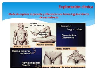Modo de explorar al paciente y diferenciar una hernia inguinal directa
de una indirecta
Exploración clínica
 