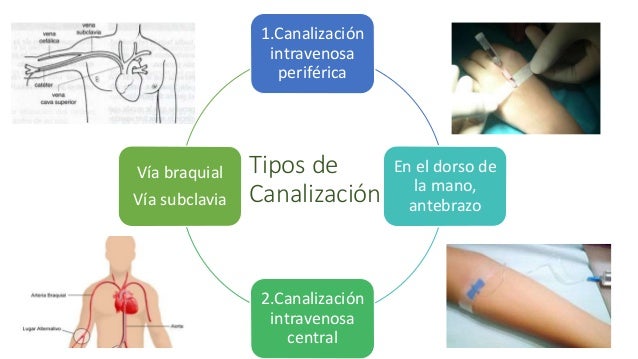 Canalización intravenosa periférica, la solución esta aqui