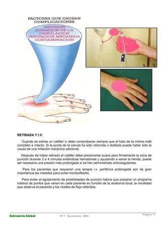 RETIRADA Y I.V. 
Cuando se extrae un catéter iv debe comprobarse siempre que el tubo de la misma esté 
completo e intacto. Si la punta de la cánula ha sido retorcida o doblada puede haber sido la 
causa de una irritación mecánica adicional. 
Después de haber retirado el catéter debe presionarse suave pero firmemente la zona de 
punción durante 3 a 4 minutos evitándose hematomas y ayudando a sanar la herida, puede 
ser necesaria una presión más prolongada si se han administrado anticoagulantes. 
Para los pacientes que requieran una terapia i.v. periférica prolongada son de gran 
importancia las medidas para evitar tromboflebitis. 
Para evitar el agotamiento de posibilidades de punción habría que preparar un programa 
rotativo de puntos que varian en cada paciente en función de la anatomía local, la movilidad 
que observa el paciente y los niveles de flujo referidos. 
Enfermería Global Nº 7 Noviembre 2005 Página 11 
 